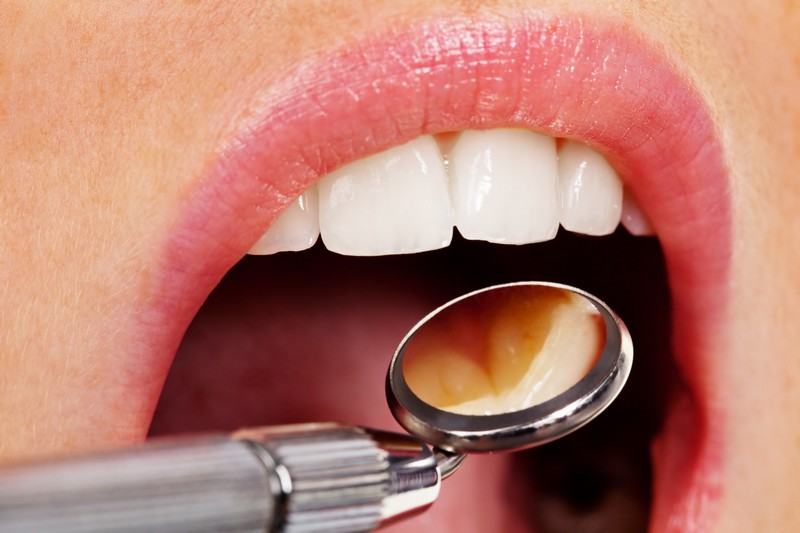 Esthetic Crown Lengthening